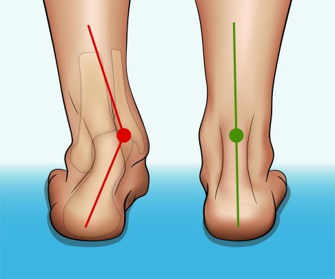 Links die Valgusstellun und rechts die gesunde Ferse